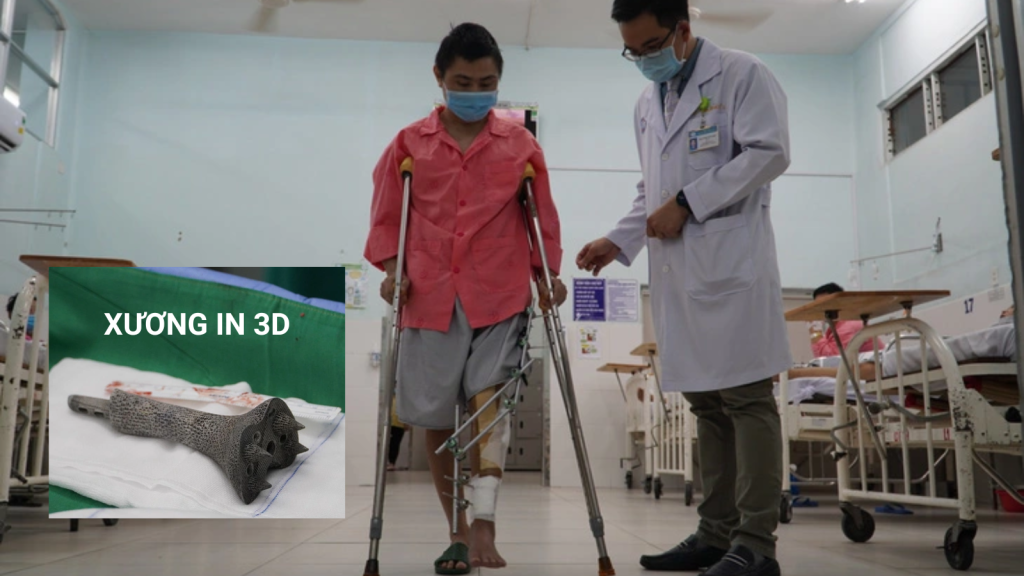 Bệnh viện Chợ Rẫy vừa rồi (ngày 5/1/2021) thực hiện thành công ca phẫu thuật sử dụng mảnh ghép in 3D hợp kim Titanium dạng tổ ong thay một đoạn xương chày cho bệnh nhân ung thư xương. Đây là kỹ thuật y tế công nghệ cao, hoàn toàn mới, và là lần đầu tiên được áp dụng thành công tại Bệnh viện Chợ Rẫy.