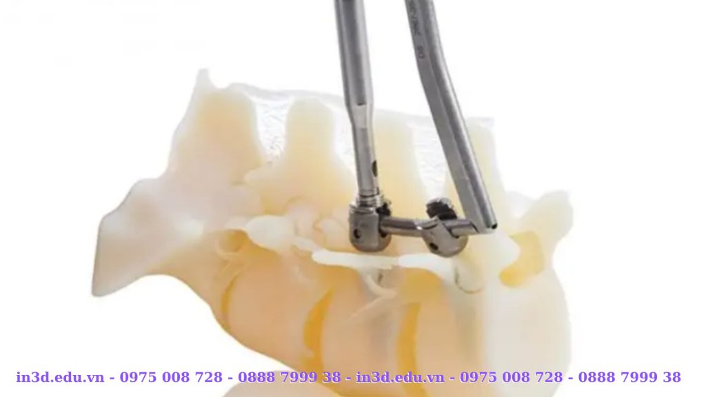 Cường Thái Group (CT3D Group) là đơn vị tiên phong tại Việt Nam cung cấp dịch vụ in 3D kim loại công nghiệp phục vụ nhiều lĩnh vực, đặc biệt là ngành y tế, nơi yêu cầu độ chính xác, an toàn sinh học và độ bền vật liệu cực cao. Với hơn 500+ dự án in kim loại thành công, CT3D Group khẳng định năng lực tiên phong trong ứng dụng công nghệ sản xuất tiên tiến này. Trong ngành y tế, công nghệ in 3D kim loại (Metal 3D Printing) mở ra kỷ nguyên mới cho việc chế tạo các bộ phận cấy ghép, dụng cụ phẫu thuật và thiết bị y tế tùy chỉnh. Các chi tiết như implant xương hàm, khớp háng, khớp gối, giá đỡ cột sống hoặc khung hỗ trợ mô mềm có thể được in trực tiếp bằng vật liệu Titanium (Ti6Al4V) hoặc Thép y sinh 316L, mang lại độ chính xác ±0.02 mm, trọng lượng nhẹ và khả năng tương thích sinh học tuyệt đối. So với phương pháp gia công truyền thống, in 3D kim loại giúp giảm 60–70% thời gian chế tạo và cho phép thiết kế cấu trúc xốp tối ưu cho quá trình tái tạo mô xương tự nhiên. CT3D Group trang bị hệ thống máy in 3D kim loại SLM công nghiệp (Selective Laser Melting) với công suất laser 500 W, buồng in khổ lớn 250 × 250 × 300 mm, đáp ứng đồng thời các vật liệu kim loại như AlSi10Mg, 316L, Inconel 718, Titanium, CoCr. Đội ngũ kỹ sư của chúng tôi có hơn 10 năm kinh nghiệm trong lĩnh vực thiết kế y sinh và cơ khí chính xác, cung cấp trọn gói giải pháp từ thiết kế mô hình 3D, mô phỏng chịu lực, in thử nghiệm, xử lý bề mặt đến kiểm định chất lượng theo tiêu chuẩn ISO 13485. Ngoài y tế, dịch vụ in 3D kim loại của Cường Thái Group (CT3D Group) còn phục vụ các ngành khuôn mẫu, hàng không, năng lượng, cơ khí và nghệ thuật kim loại cao cấp. Chúng tôi cam kết mang đến giải pháp tối ưu về kỹ thuật, vật liệu và chi phí, giúp doanh nghiệp Việt Nam chủ động hơn trong sản xuất công nghệ cao, sẵn sàng hội nhập chuỗi cung ứng toàn cầu.
